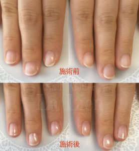 爪甲縦条 そうこうじゅうじょう 会津若松市にあるアラサーから始める プチごほうび型ネイルサロン